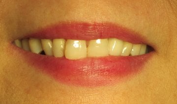 After partial denture by Dental Implant Pro