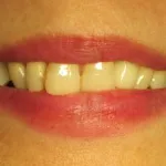 After partial denture by Dental Implant Pro