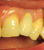 Closeup of partial denture by Dental Implant Pro