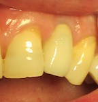 Closeup of partial denture by Dental Implant Pro