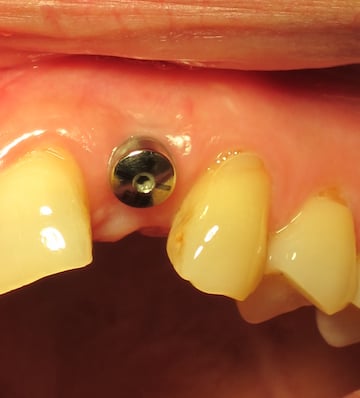Dental Implant placed by Dental Implant Pro