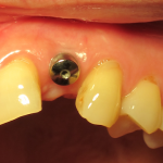 Dental Implant placed by Dental Implant Pro