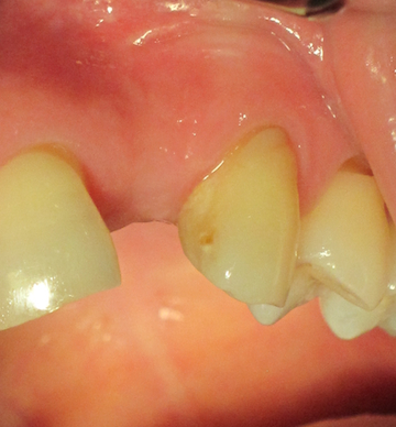 Before Dental Implant by Dental Implant Pro