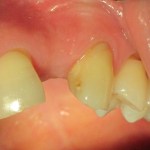 Before Dental Implant by Dental Implant Pro