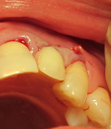 After Dental Implant restoration placed by Dental Implant Pro