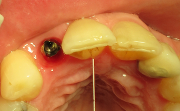 Dental Implant placed