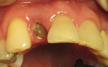 Before Dental Implant