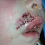 child's upper lip repaired