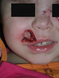 child's damaged upper lip