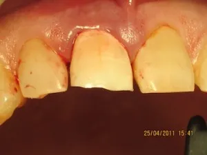 knocked out tooth repaired