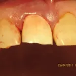 knocked out tooth repaired