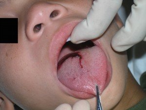 child's tongue laceration