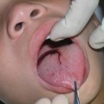 child's tongue laceration
